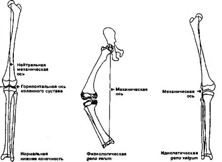 Рис. 22.12. Нормальная и искривленная нижняя конечность. (Приводится с разрешения из: Staheli L.T.: Pediatrics Orthopedic Secrets, Philadelphia, Hanley & Belfus, 1998)