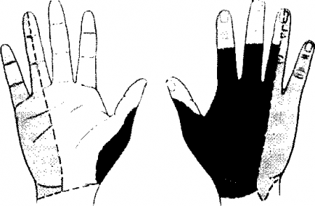 Рис. 22.2. Зоны иннервации кожи срединного нерва (окрашены белым цветом), локтевого нерва Ссветлая тень), лучевого нерва (темная тень). (Приводится с разрешения из: Сопсаппоп M.J.: Common Hand Problems in Primary Care. Philadelphia, Hanley & Belfus, 1999)