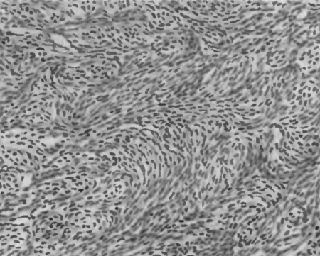 Рис. 34. Лейомиома. Пучки гладких мышечных клеток различной толщины, расположены неравномерно.