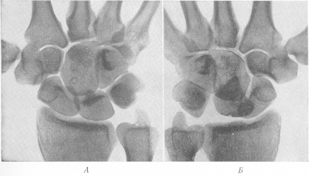 Рис. 75. Рентгенограмма запястья в ладонном положении. А — нормальная левая сторона для сравнения; Б — вывих полулунной кости.