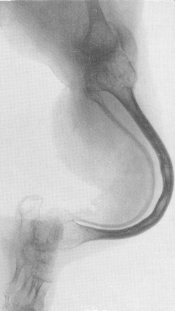 Рис. 267. Идиопатический остеопсатироз у 45-летней женщины. Типичная рентгенологическая картина обезображивания костей голени.  