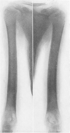Рис. 289. Врожденные системные диафизарные гиперостозы у той же девочки. Рентгенограмма обеих плечевых костей.