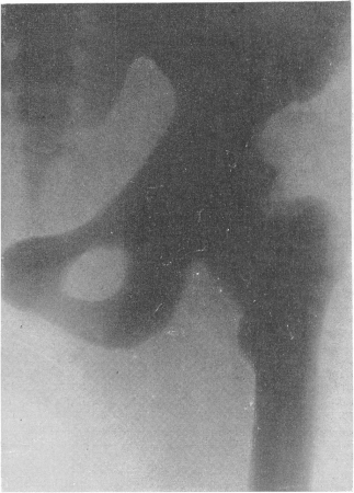Рис. 311. Врожденная мраморная болезнь у 39-летней женщины, случайно обнаруженная при рентгенологическом исследовании в связи с переломом лучевой кости. Нормальная картина крови, отсутствие биохимических сдвигов. Рентгенограмма области левого тазобедренного сустава.