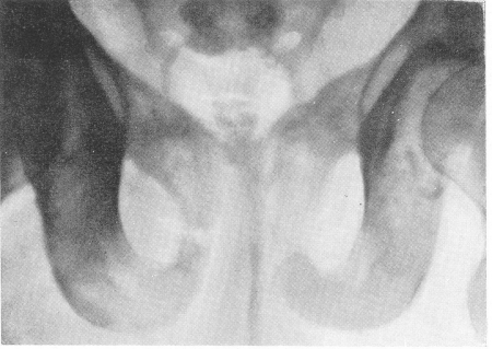 Рис. 324. Врожденный черепно-ключичный дизостоз у той же больной. Агенезия симфиза лонных костей из-за недоразвития последних.