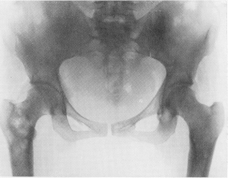 Рис. 348. То же наблюдение. Рентгенограмма таза. Очаги в проксимальном конце правой бедренной кости и в восходящей ветви левой седалищной кости.