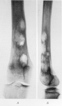 Рис. 347. Эозинофильные гранулемы у 38-летней больной. Множественные деструктивные очаги в дистальной половине бедренной кости. Гистологическое подтверждение диагноза. А — прямая рентгенограмма; Б — боковая рентгенограмма.
