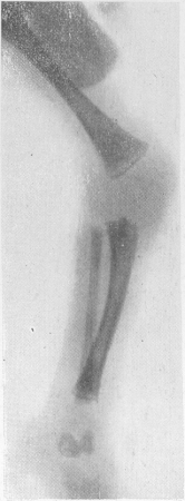Рентгенограмма длинных трубчатых костей нижней конечности у 4-месячного ребенка, страдающего общим сепсисом с тяжелой сопутствующей анемией. Сифилис заведомо исключен. Подчеркнутые зоны предварительного обызвествления и светлые поперечные метафизарные полоски. Костные изменения имеют системный симметричный характер.