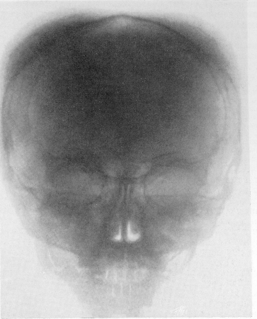 Рис. 353. Эритробластическая анемия Кули. Та же больная. Рентгенограмма черепа. Характерный гиперостоз покровных костей свода.