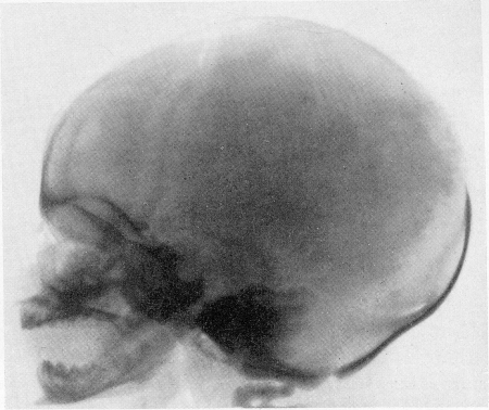 Рис. 355. Рентгенограмма черепа новорожденного ребенка с эритробластозом (гемолитической анемией и врожденной желтухой). В теменной кости — поперечно расположенные костные разрастания.
