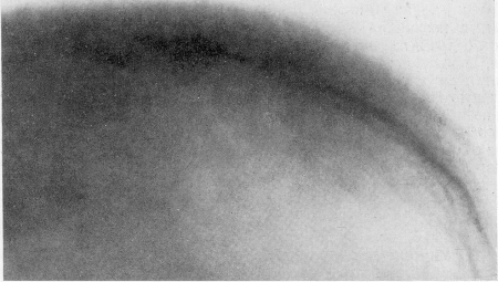 Рис. 354. Эритробластическая анемия Кули. Та же больная. Деталь рентгенограммы лобно-теменной области черепа. Типичная картина поперечной игольчатой исчерченности—картина „ежика”.