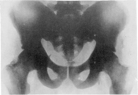 Рис. 356. Так называемая остеосклеротическая анемия (миелофиброз, миелосклероз( у 36-летней больной. Рентгенограмма таза. Картина мраморности костей в тяжело протекавшем случае заболевания. Секционное подтверждение диагноза.