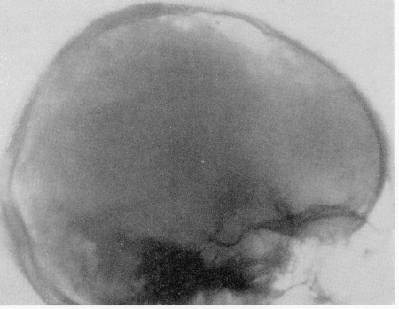 Рис. 358. Так называемая остеосклеротическая анемия у 63-летней больной. Рентгенограмма черепа. Секционное подтверждение диагноза.