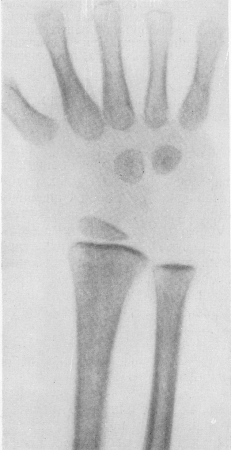 Рис. 362. Рентгенологические изменения скелета области лучезапястного сустава у мальчика 3,1/2 лет с алейкемическим лейкозом. Метафизарная полоска просветления и подчеркнутая зона предварительного обызвествления при общем остеопорозе. Секционное подтверждение.