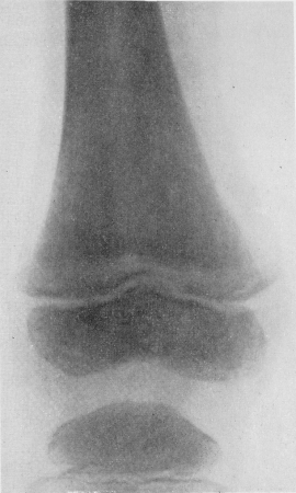 Рис. 363. Рентгенограмма области коленного сустава того же больного. Те же изменения в ростковой зоне.