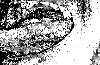 Рис. 6.5. «Волосатая» лейкоплакия полости рта. (Приводится с разрешения из: Fitzpatrick J.E., Aeling J.L.: Dermatology Secrets. Philadelphia, Hanley Belfus, 1996)