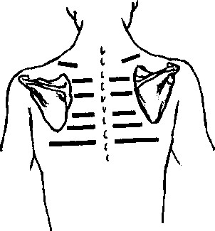 Рис. 13.8. Участки определения голосового дрожания на задней поверхности грудной клетки (Приводится с разрешения из: Swartz М.Н.: Textbook of Physical Diagnosis, 3rd ed. Philadelphia, W.B. Sounders, 1997)