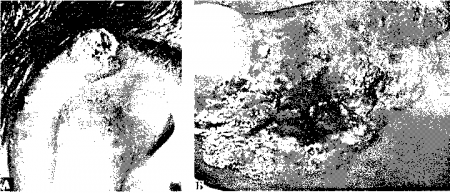 Рис. 3.5. А. Плоскоклеточный рак уха в виде узла, покрытого в центре чешуйками и корками. Б. Неороговевающий плоскоклеточный рак. Нередко достигает больших размеров, поскольку часто подолгу лечится как бородавка. (Приводится с разрешения из: Fitzpatrick J.E., Aeling J.L.: Dermatology Secrets. Philadelphia. Hanley and Belfus, 1996.)
