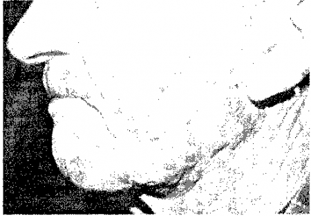Рис. 3.11. Синдром Свита у пожилого мужчины. (Приводится с разрешения из: Fitzpatrick J.E., Aeling J.L.: Dermatology Secrets. Philadelphia. Hanley and Belfus, 1996.)