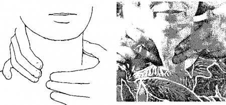 Рис. 8.4. Б. Пальпация контралатеральной доли щитовидной железы, задний доступ
