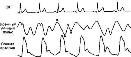 Рис. 10.7. Одновременная запись электрокардиограммы (верхняя кривая), яремного венного пульса (средняя кривая) и давления в сонной артерии (нижняя кривая). (Приводится с разрешения из: Adair O.V., Havranek Е.Р.: Cardiology Secrets, Philadelphia, Hanley & Belfus, 1995)