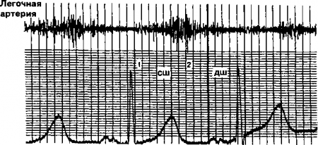 Рис. 12.8. Постоянный шум при открытом артериальном протоке. (Приводится с разрешения из: Fyler D.C.: Nadas’ Pediatric Cardiology. Philadelphia, Hanley & Belfus, 1992).