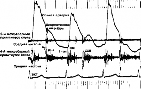 Рис. 12.10. Шум аортальной рсгугитации. ДШ — диастолический шум; СШ — систолический шум (Приводится с разрешения из: Fyler D.C.: Nadas’ Pediatric Cardiology. Philadelphia, Hanley & Belfus, 1992)