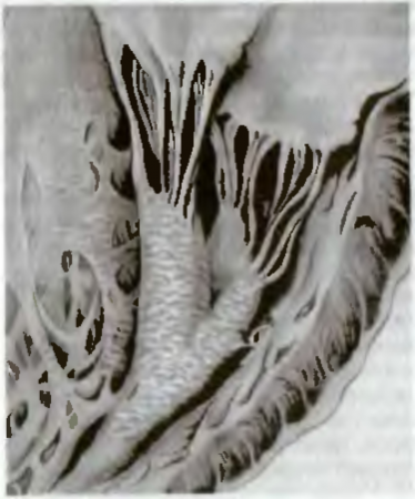 ЖИРОВЫЕ ДИСТРОФИИ (ЛИПИДОЗЫ). Рис. 4. Жировая дистрофия миокарда ("тигровое сердце"). Под эндокардом видны желто-белые полоски, соответствующие участкам включения липидов в кардиомиоцитах.