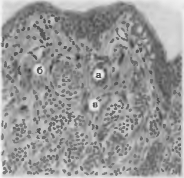 Рис. 41. Пигментный невус. Меланинсинтезирующие клетки образуют островки (а), разделенные прослойками соединительной ткани (б). Зерна меланина в цитоплазме соединительнотканных клеток (в).