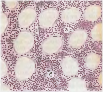 Рис. 44. Костный мозг при остром лимфобластном лейкозе. Ткань мозга состоит в основном из лимфобластов (а), просветы сосудов заполнены теми же клетками (б).