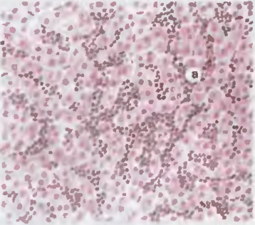 Рис. 46. Печень при хроническом миелолейкозе. Разрастание клеток миелоидного рода (а) по ходу синусоидов.