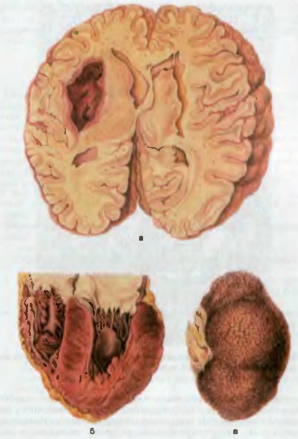 гипертоническая болезнь кровоизлияние в мозг