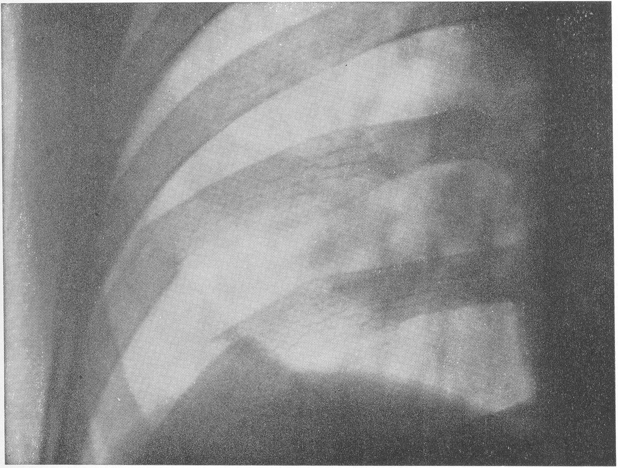 Перелом ребер трещина ребра. Перелом 11 ребра слева на рентгене. Перелом ребра снимок рентген.