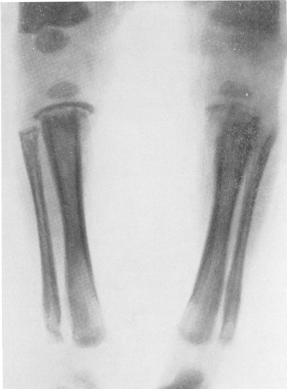 Снимок верхней конечности больного третичным сифилисом