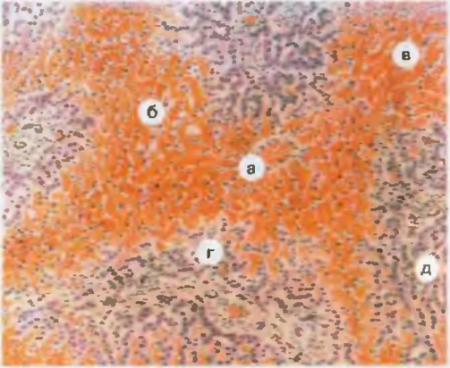 НАРУШЕНИЯ КРОВОБРАЩЕНИЯ И ЛИМФООБРАЩЕНИЯ. Рис. 16. Хроническое венозное полнокровие печени (мускатная печень). В центре долек центральные вены и синусоиды резко расширены, полнокровны (а), печеночные клетки атрофичны (б), в области кровоизлиянии (в) разрушены. По периферии долек печеночные балки сохранены (г), перисинусоидальные пространства расширены (д).