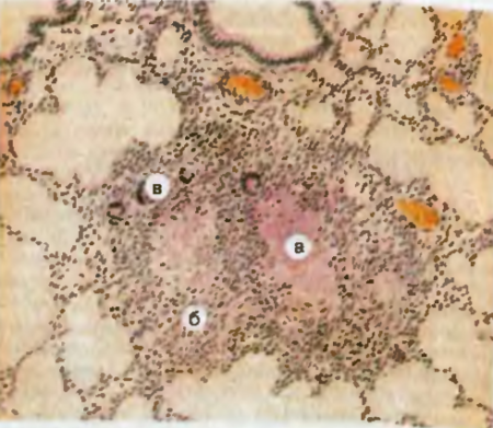 ВОСПАЛЕНИЕ. Рис. 27. Туберкулезные узелки (гранулемы) в легких. Казеозный некроз центральной части гранулем (а); на границе с фокусами некоза эпителиоидные клетки (б) и гигантские клетки Пирогова—Лангханса (в) периферии гранулем скопления лимфоидных клеток.