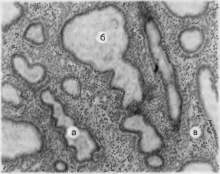 ПРИСПОСОБИТЕЛЬНЫЕ И КОМПЕНСАТОРНЫЕ ПРОЦЕССЫ. Рис. 32. Железисто-кистозная гиперплазия слизистой оболочки матки. Железы извиты, просветы некоторых из них кистозно расширены (б), строма богата клетками (в).