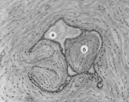 Рис. 35. Интраканаликулярная фиброаденома молочной железы. Железистые образования опухоли (а) сжаты пучками стромы (б).