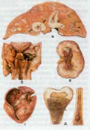 БОЛЕЗНИ СИСТЕМЫ КРОВИ. Рис. 45. Острый лейкоз, а — лейкозная инфильтрация печени (показано стрелками); б — некроз миндалины (некротическая ангина); в — лейкозная инфильтрация почек; г — множественные кровоизлияния в эпикарде и эндокарде; д — лейкозная инфильтрация костного мозга (пиоидный костный мозг), истончение кортикального слоя бедренной кости (показано стрелкой).
