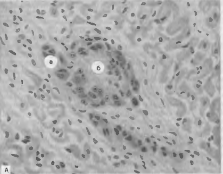 РЕВМАТИЧЕСКИЕ БОЛЕЗНИ. Рис. 55. Ревматическая гранулема Ашоффа— Галалаева в строме миокарда. Гранулема состоит из гистиоцитов с базофильной цитоплазмой (а), в центре гранулемы — очаг фибриноидного некроза соединительной ткани (б).