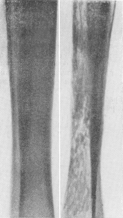 Рис. 3. Распространенный пороз костей левой голени у 53-летнего мужчины после операции наложения лигатуры на подколенную вену в связи с гангреной левой стопы.