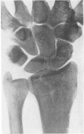 Рис. 10. Т-образный перелом дистального эпифиза лучевой кости.