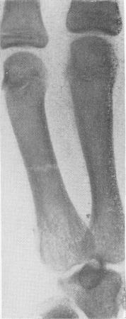 Рис. 6. Поперечный перелом V пястной кости.