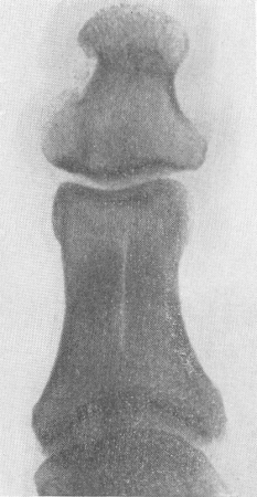 Рис. 8. Продольный перелом основной фаланги большого пальца стопы.