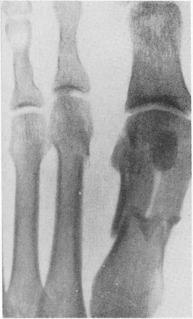 Рис. 11. Оскольчатый перелом I плюсневой кости и поперечный перелом шейки II плюсневой кости.