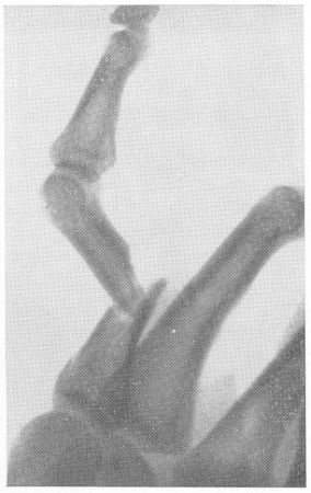Рис. 22. Резко выраженное угловое смещение отломков при переломе диафиза основной фаланги одного из пальцев руки. Всякое угловое смещение, даже самое незначительное, требует исправления.
