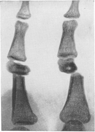 Рис. 23. Т-образное смещение отломков при поперечном переломе диафиза основной фаланги пальца руки.