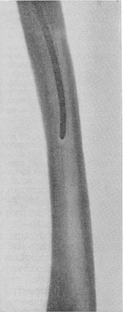 Рис. 27. Реактивный остеосклеротический футляр вокруг металлического штифта в костномозговом канале бедренной кости, развившийся после полуторалетнего его пребывания.
