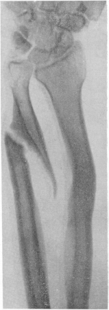 Рис. 33, Ложный сустав локтевой кости с деформацией лучевой кости после плохо леченного перелома предплечья.