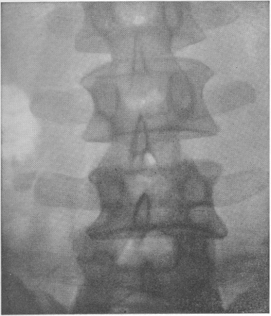 Рис. 51. Ложный сустав, развившийся после перелома поперечного отростка IV поясничного позвонка с правой стороны. В анамнезе— сильный прямой удар в спину в этой области.