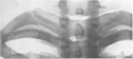 Рис. 60. Перелом I ребра справа близ шейки у 16-летнего юноши, сорвавшегося с телеграфного столба. Боли в верхней части груди и спины.